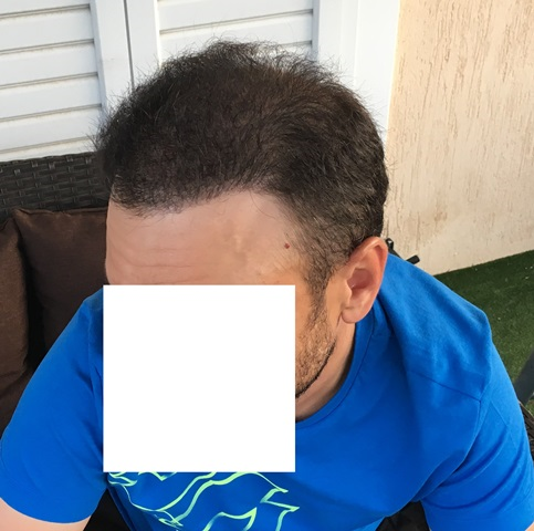After 5600 Grafts side view
