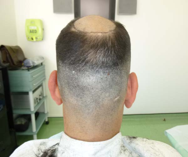 Recipient area before the procedure shaved