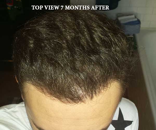 7 Months After   Top View