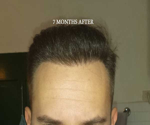 Hairline   7 Months Post Op