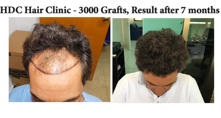 Before And After To View 3000 Grafts   Banay