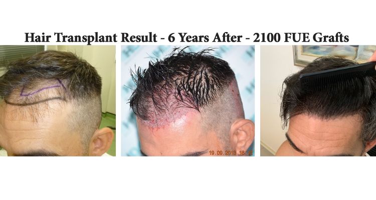 Hair Transplant Result   6 Years After   2100 Grafts   Left Side
