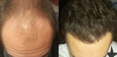 Hair Transplant Result - 3150 Grafts FUE - NW4