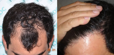 Risultato di Trapianto di capelli - 3045 Innesti FUE - NW3