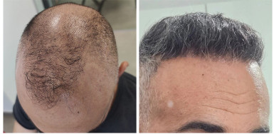 FUE repair Result after 6026 Grafts in two Sessions – Dr Maras