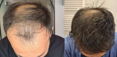 Hair Transplant Result - 0 to 7 months for 4350 FUE – HDC Hair Clinic with Dr Christina