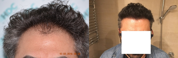 Hair transplant result – FUE 2700 – Class 3 – HDC Hair Clinic