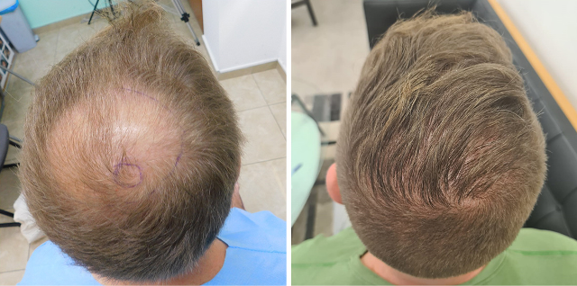 Crown FUE Result – 2900 grafts – 1 Year after 