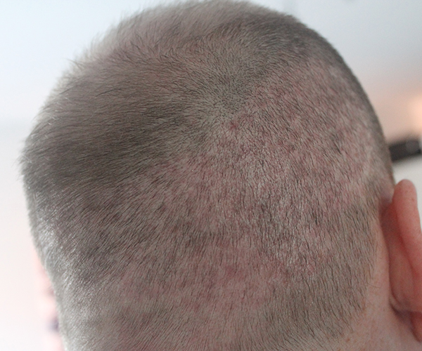 Hair Transplants HDC - Avoid scarring & Donor Depletion in FUE