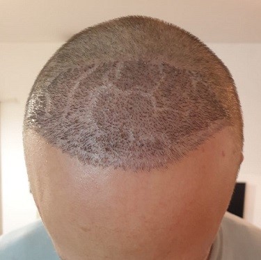 Dryness in Recipient Area after a Hair Transplant