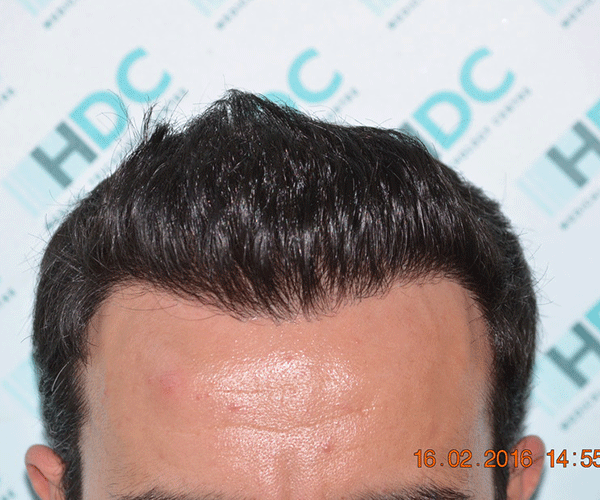 Close up of the hairline 9 months after the procedure