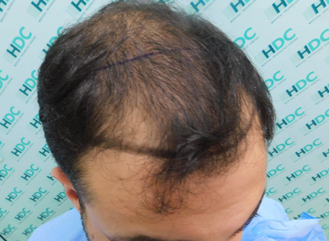 Hair Transplant Result After 27 Months – 3200 Grafts – HDC Hair Clinic