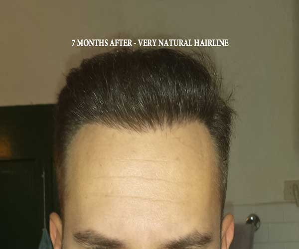 7 Months   Hairline