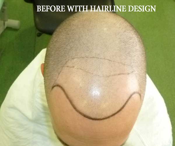 Before Of With Hairline Design