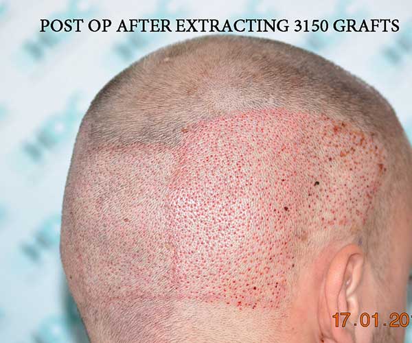 Post Op After Extracting 3150 Grafts