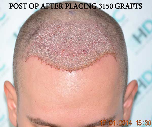 Post Op After Placing 3150 Grafts