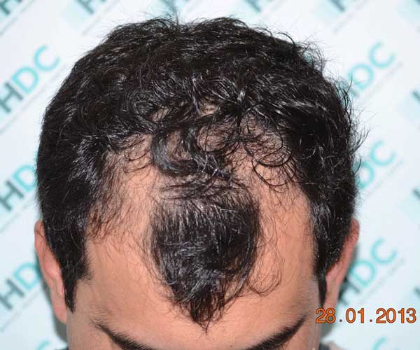 Comparison before and 7 months after the hair transplant surgery