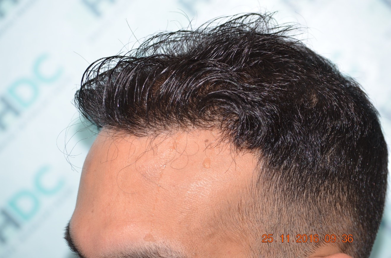 FUE Technique | Hair Transplants in Cyprus