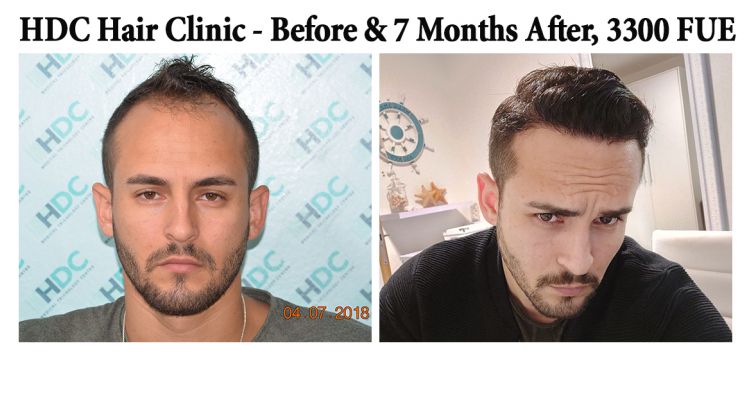 HDC Hair Clinic in Brief