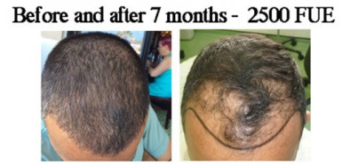 7 Αποτελέσματα μεταμόσχευσης μαλλιών μπροστινής γραμμής με τη μέθοδο FUE