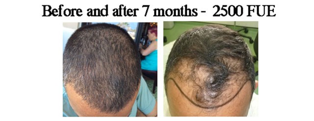 7 Hair Transplant Hairline FUE Results in 2014