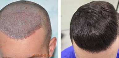 Before with SMP and After 8 months with 3000 FUE 