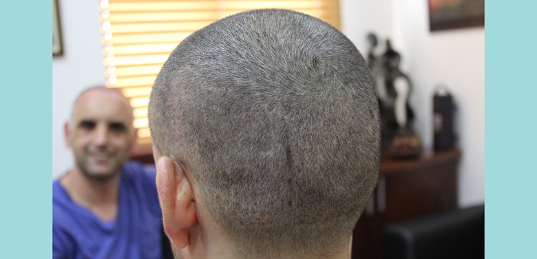 Avoiding swelling and Achieving fast donor Healing in FUE Hair Transplantation
