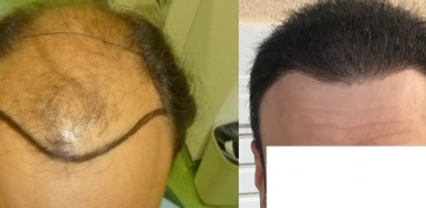 5600 grafts 0 – 6.5 months in 2 hair transplants – Class 6 patient – HDC Hair Clinic