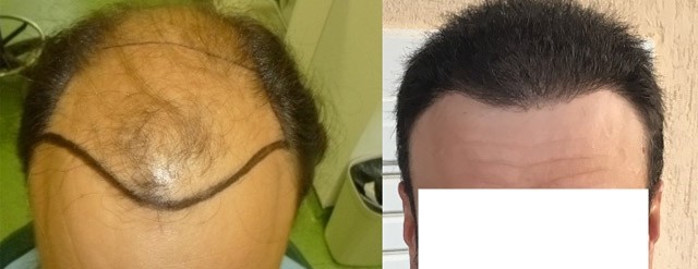 5600 grafts 0 –  months in 2 hair transplants – Class 6 patient – HDC  Hair Clinic