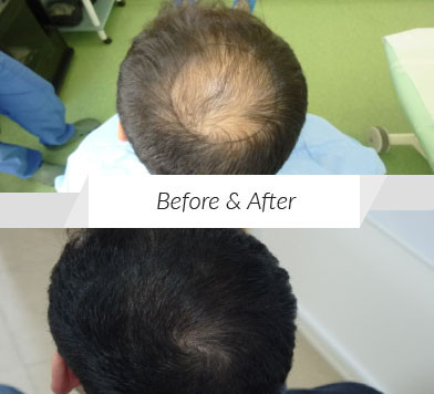 2200 grafts for Crown Coverage