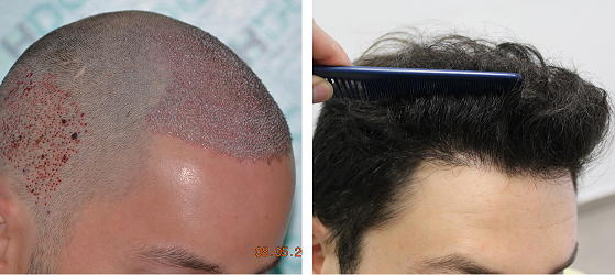 Before and after 1 Year - 3000 FUE grafts
