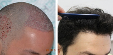 Before and after 1 Year - 3000 FUE grafts 