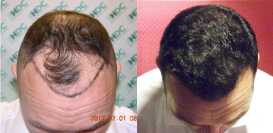 Hair transplant result – FUE 3050 – Class 3V – HDC Hair Clinic