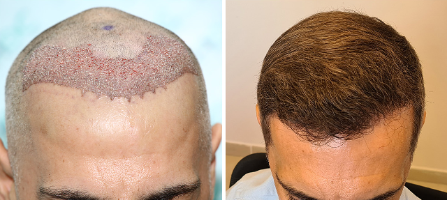 Hairline Restoration Result - 2800 FUE grafts – Before and After 8 months 