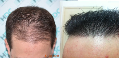 Hair transplant result – FUE 3050 – Class 3 – HDC Hair Clinic
