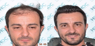 Hair Transplant Result - 3112 Grafts FUE - NW4