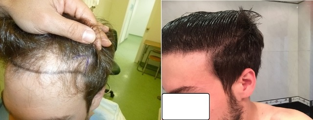 FUE Hair Transplant Result – 26 months – 2400 grafts – NW3 – HDC Medical Clinic