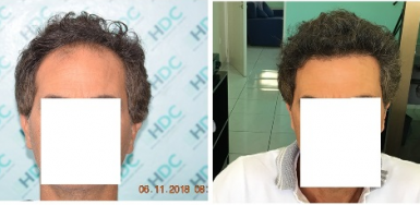 3000 grafts FUE Hair Transplant Result - 0 to 7 months 
