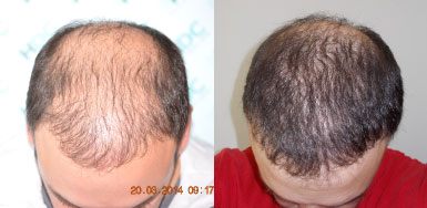 Hair transplant result – FUE 5386 – NW5 – HDC Hair Clinic