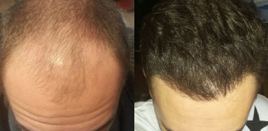 Hair Transplant Result - 3150 Grafts FUE - NW4