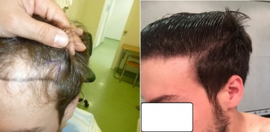 FUE Hair Transplant Result – 26 months – 2400 grafts – NW3 – HDC Medical Clinic