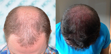 Hair transplant result – 4538 FUE & BEARD FUE – NW6 – HDC Hair Clinic