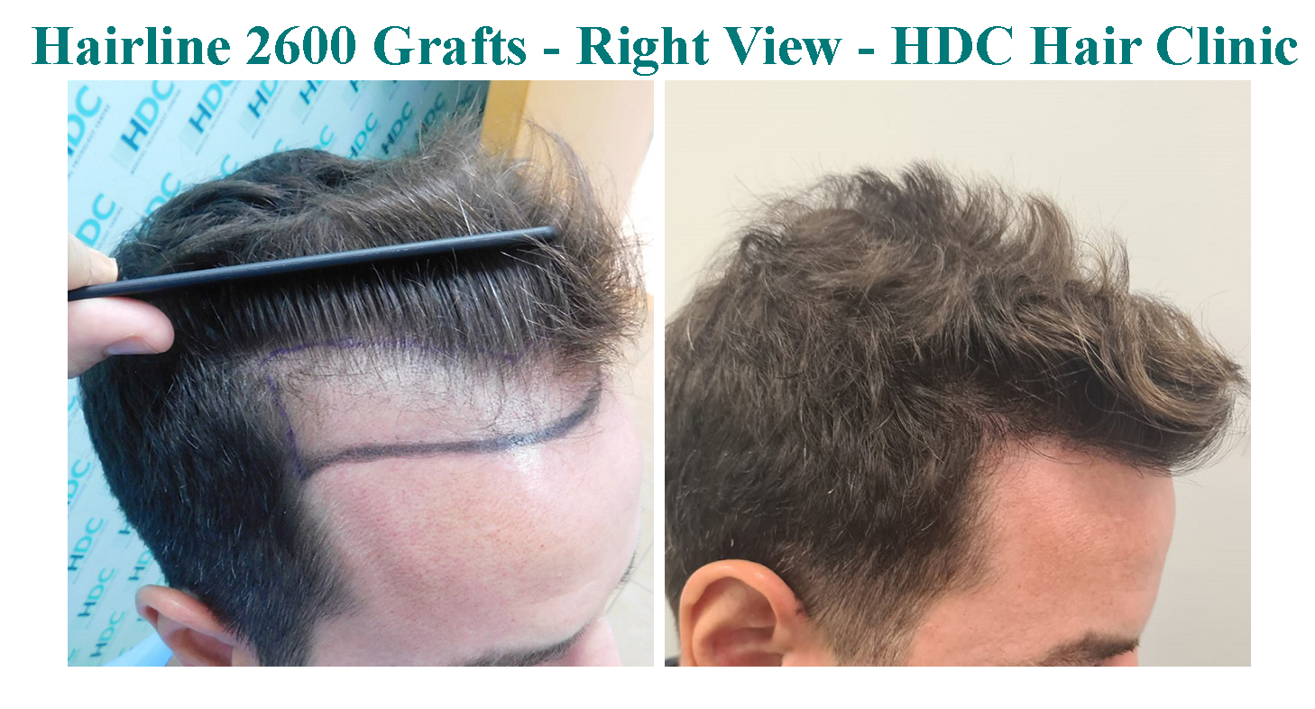 Lowering of Hairline – 2680 FUE Grafts – HDC Hair Clinic 