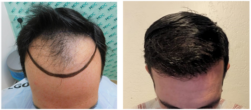 Dr Christina - Before and after 3520 FUE Grafts 
