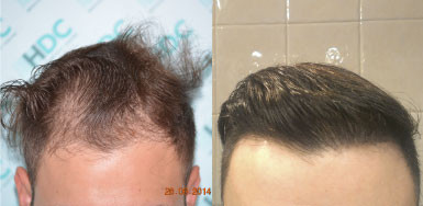 Hair transplant result – FUE 2014 – Class 2-3 – HDC Hair Clinic