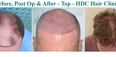 7650 grafts - Hair Transplant Result – 2 Sessions – 1 year - Class 5-6 Patient