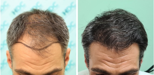 0 to 8 months After - FUE Result for 3075 grafts