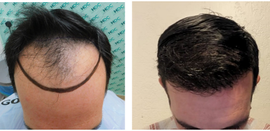 Dr Christina - Before and after 3520 FUE Grafts 