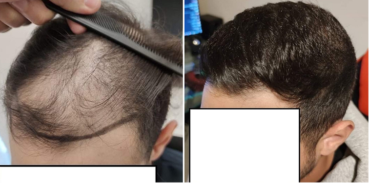 FUE Result 3 Years after for 3520 grafts – Dr Maras