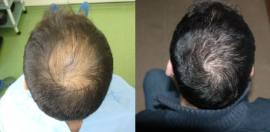 Hair transplant result – FUE 2200 – Crown – HDC Hair Clinic